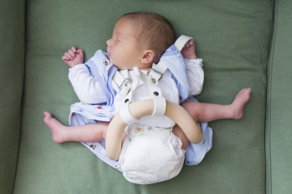 Bebeklerde Kalça Çıkığı Ve Tedavi Aşamaları