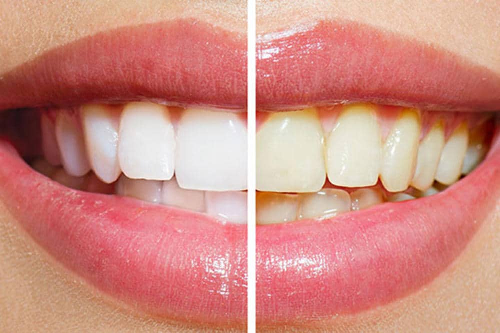 Doğal Diş Beyazlatma Yöntemleri
