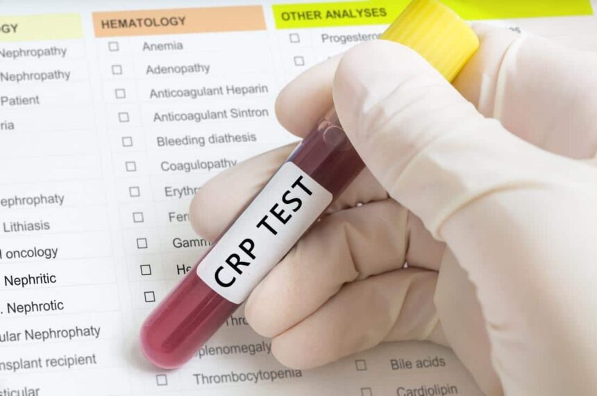 CRP Nedir? CRP Testi Ne Kadar Sürede Çıkar?